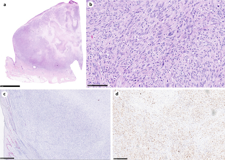 Amelanotic Melanoma Arising in Surgical Cicatrix: A Case Report.