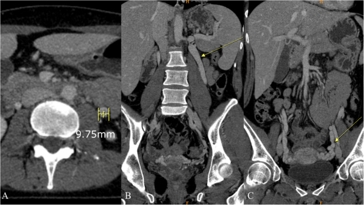 Controversies in treating nutcracker syndrome.