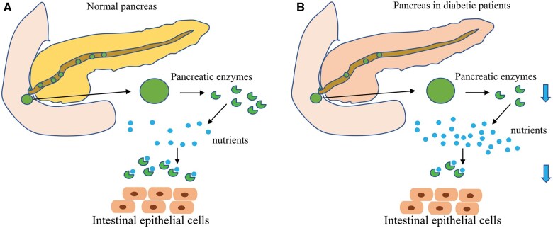 Etiologies of exocrine pancreatic insufficiency.