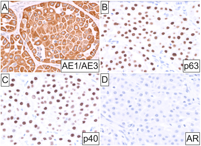Oncocytic Mucoepidermoid Carcinoma of the Parotid Gland.
