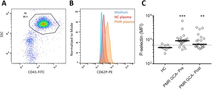 Mitochondrial-Mediated Platelet Activation in Polymyalgia Rheumatica.