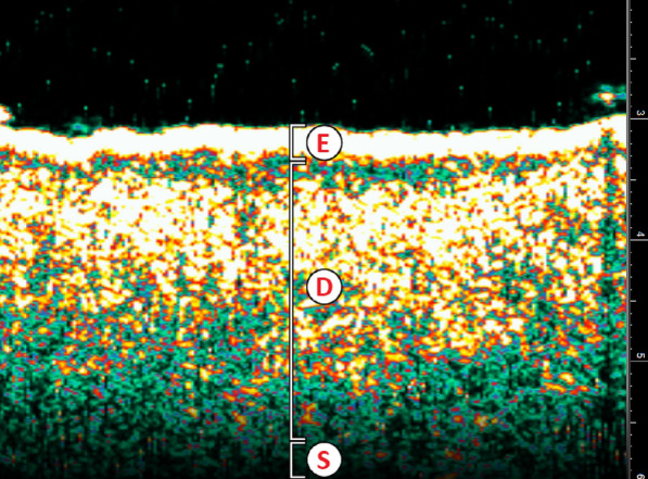 The State of the Art of Image Guided Superficial Radiation Therapy Treatment of Non-melanoma Skin Cancer in Outpatient Dermatology Clinics in the United States and Review of the Literature.