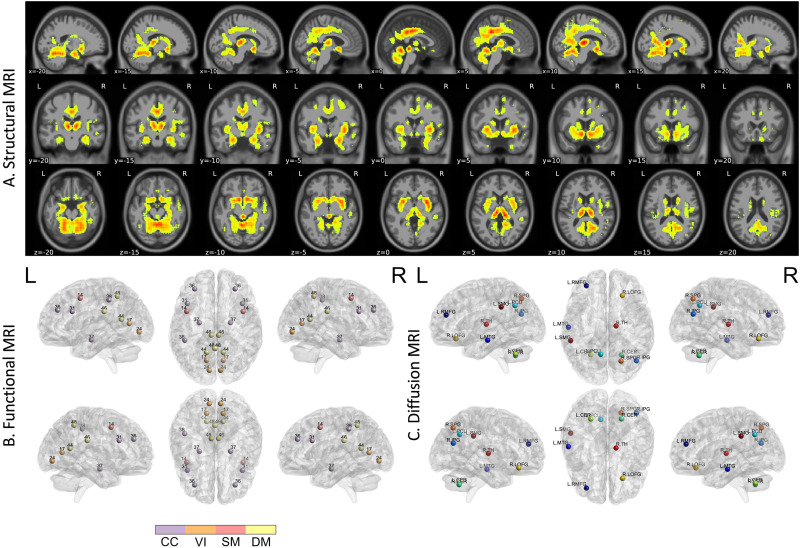 Multimodal MRI accurately identifies amyloid status in unbalanced cohorts in Alzheimer's disease continuum.
