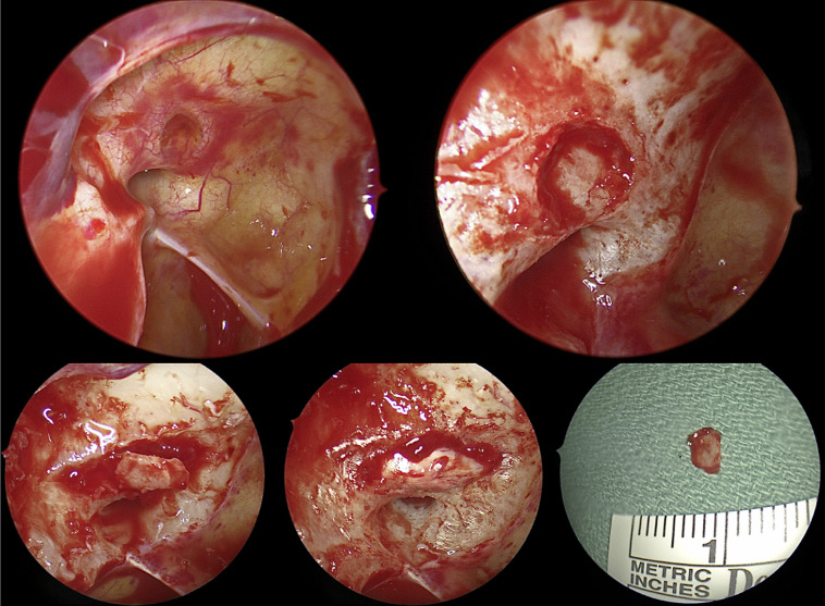 Orbital Fracture Resulting in Contralateral Optic Canal Fracture with Traumatic Optic Neuropathy: A Case Report.
