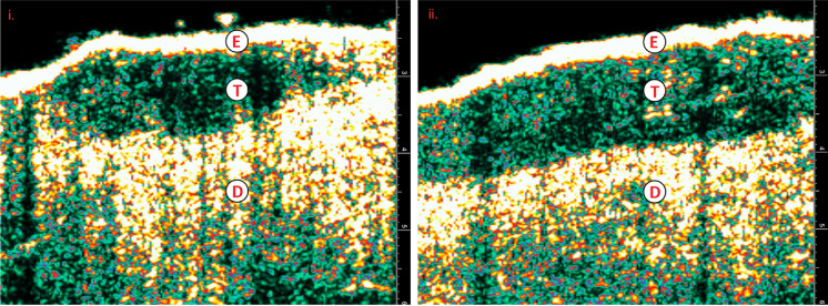 The State of the Art of Image Guided Superficial Radiation Therapy Treatment of Non-melanoma Skin Cancer in Outpatient Dermatology Clinics in the United States and Review of the Literature.