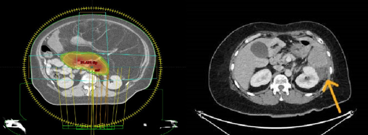 Feasibility and safety study of ultra-hypofractionated neoadjuvant radiotherapy to margins-at-risk in retroperitoneal sarcoma.