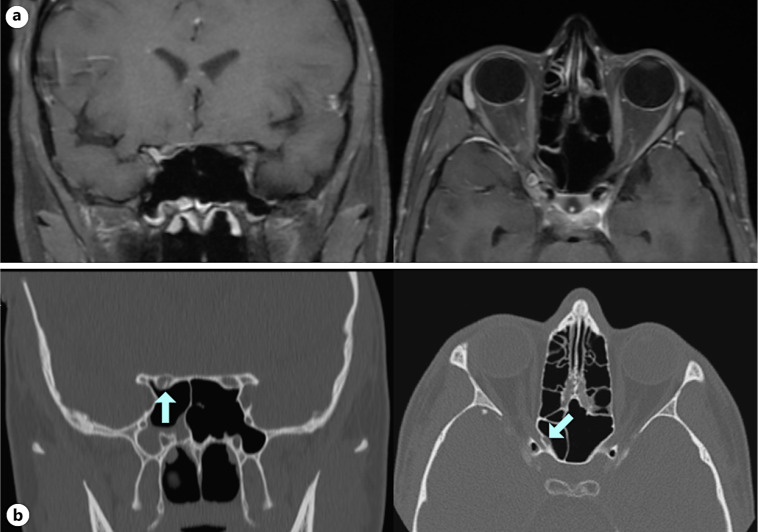 Orbital Fracture Resulting in Contralateral Optic Canal Fracture with Traumatic Optic Neuropathy: A Case Report.