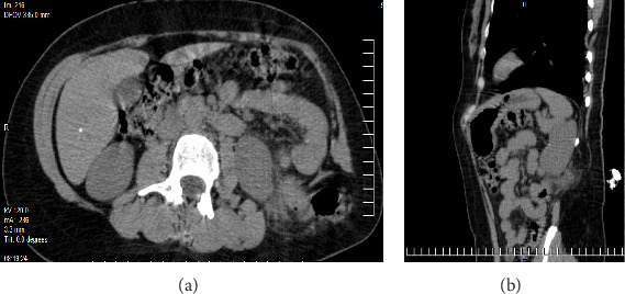Clinical Presentation and Surgical Management of a Grynfelt Hernia: Report of a Clinical Case and Literature Review.