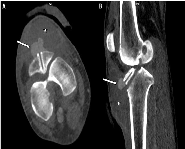 Endovascular treatment of a pseudoaneurysm in the right inferomedial genicular artery after arthroscopic anterior cruciate ligament reconstruction: a case report.