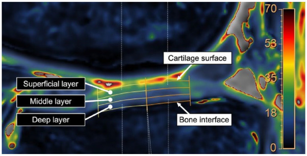 Ultra-Short Echo Time-MRI T2* Mapping of Articular Cartilage Layers Is Associated with Histological Early Degeneration.