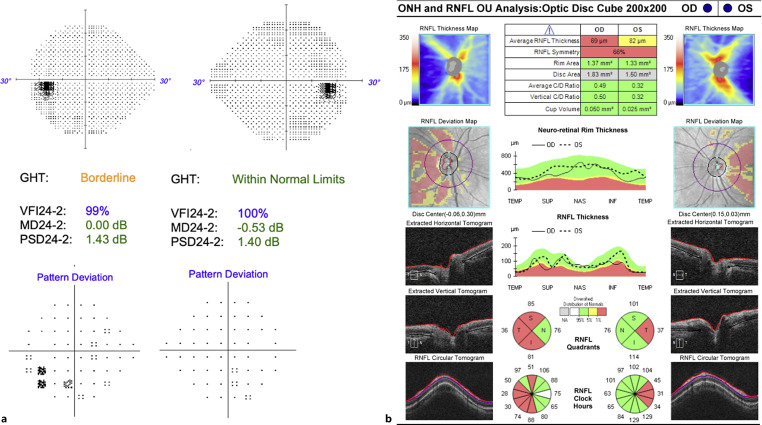 DNAJC30 Mutation in a Patient with Coexisting Leber's Hereditary Optic Neuropathy and Multiple Sclerosis (Harding's Syndrome): A Case Report.