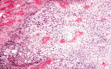 Calvarial Chondroplastic Osteosarcoma With Distant Brain Metastasis Treated With Radiosurgery: A Rare Case Report.