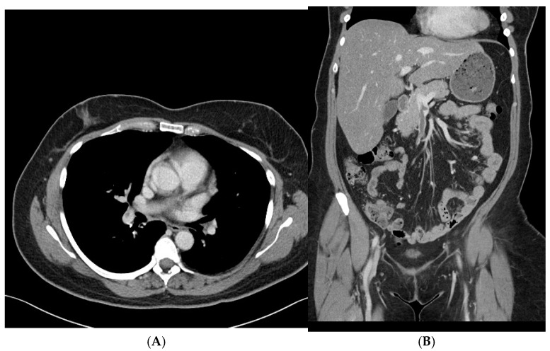 Acute Intracerebral Hemorrhage Associated with Extensive Venous Thrombosis Due to Spontaneous Heparin-Induced Thrombocytopenia After Total Knee Replacement: A Case Report.