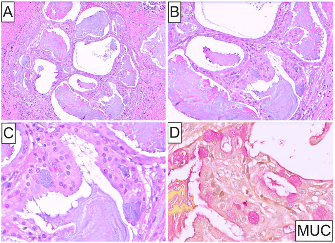 Oncocytic Mucoepidermoid Carcinoma of the Parotid Gland.