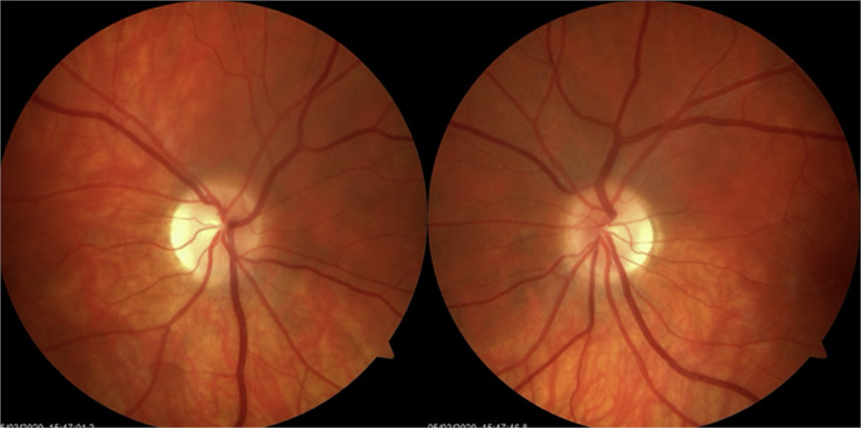 DNAJC30 Mutation in a Patient with Coexisting Leber's Hereditary Optic Neuropathy and Multiple Sclerosis (Harding's Syndrome): A Case Report.
