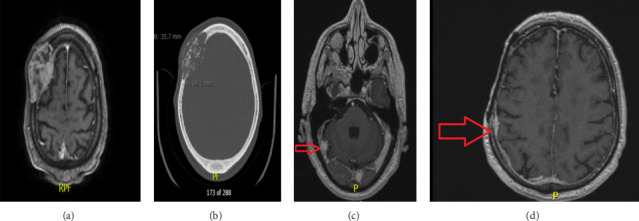 Calvarial Chondroplastic Osteosarcoma With Distant Brain Metastasis Treated With Radiosurgery: A Rare Case Report.