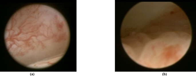Can provision of additional arthroscopic video material improve accuracy of assessment of temporomandibular joint disorders by dental Non-experts vs. MRI alone: An exploratory study in 3rd to 5th year German dental students.