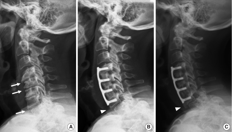 Risk Factors for "Adjacent-Level Ossification Development" Other Than Short Plate-to-Disc Distance and Clinical Implications for Adjacent-Segment Pathology.