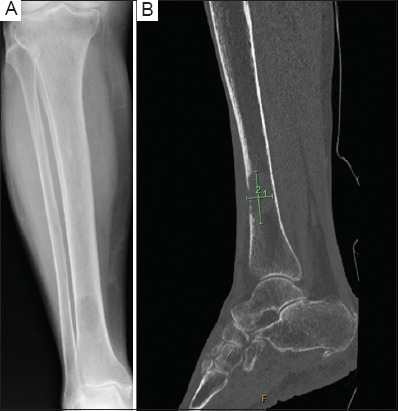 An unusual distal tibial metastasis from urothelial carcinoma: A case report.