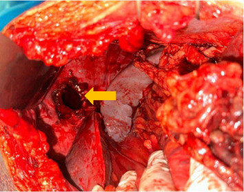 Post-Traumatic Diaphragmatic Hernia Presenting as Bowel Obstruction 12 Years After a Chest Gunshot Wound: A Rare Delayed Diagnosis.
