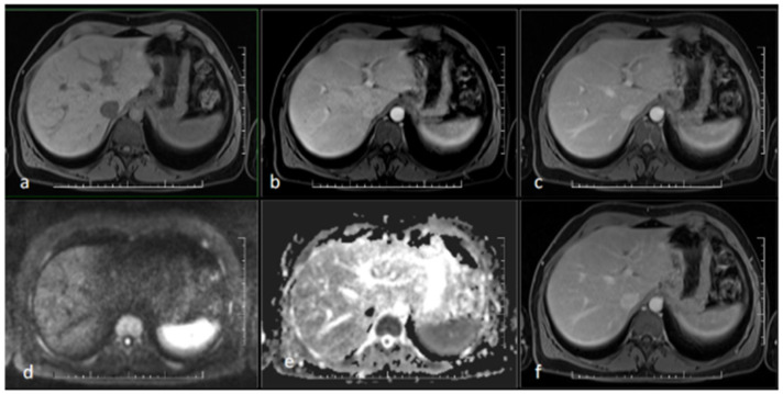Syphilitic Cholangiopathy Mimicking Primary Sclerosing Cholangitis.