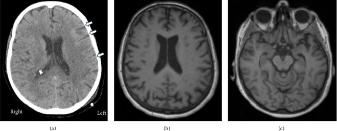 Psychosis After Mild Traumatic Brain Injury and the Role of an Integrated Brain Medicine Clinic.