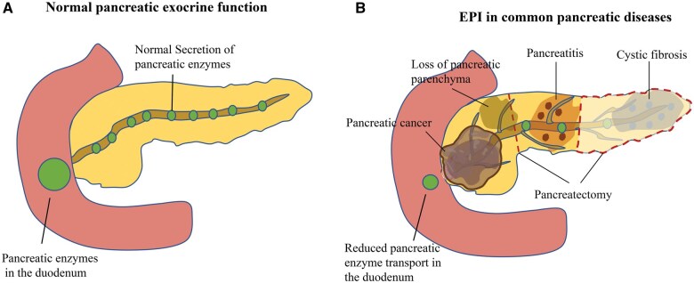 Etiologies of exocrine pancreatic insufficiency.