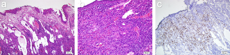 Ocular Manifestations of Kaposi Sarcoma: Insights from an HIV-Positive Patient and an Immunocompetent HIV-Negative Patient.
