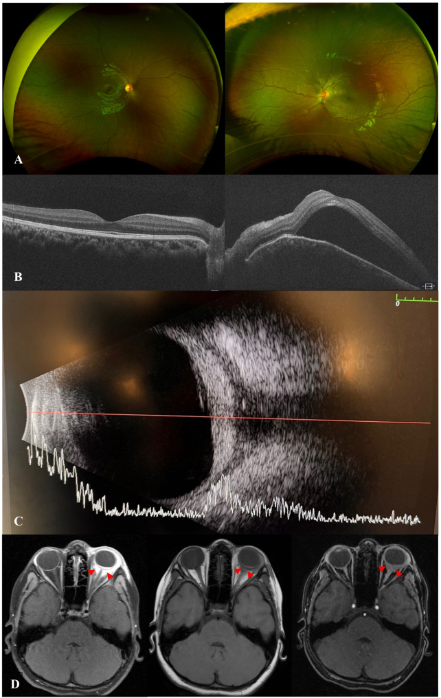 IgG4-related ophthalmic disease presenting as posterior scleritis in a pediatric patient.