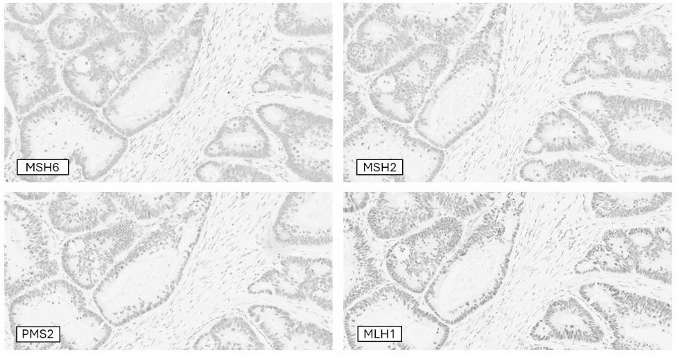 Novel MSH6 exon 5-6 skipping variant in a Taiwanese family with Lynch syndrome: implications for genetic testing and cancer management.