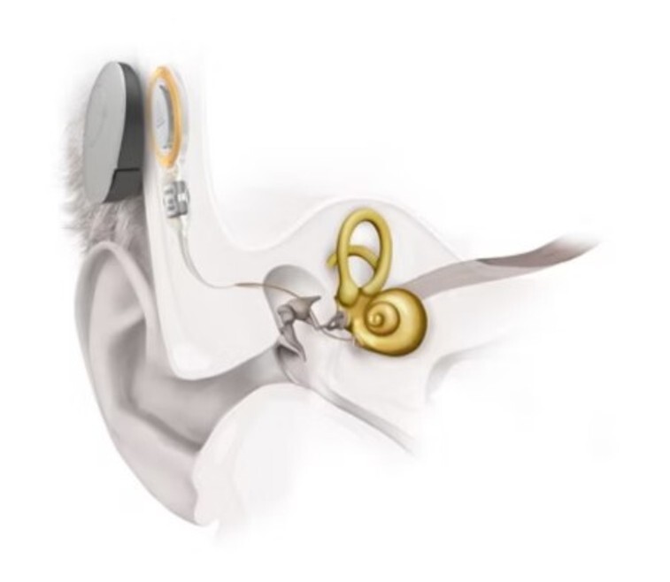 Effect of active middle ear implant on auditory speech perception in individuals with ear malformation.