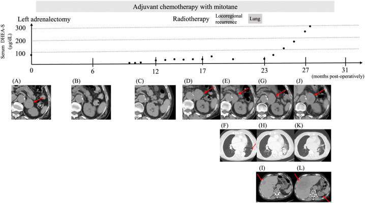 Adrenocortical carcinoma with circulating tumor DNA analysis at post-operative recurrence: a case report with review of literature.