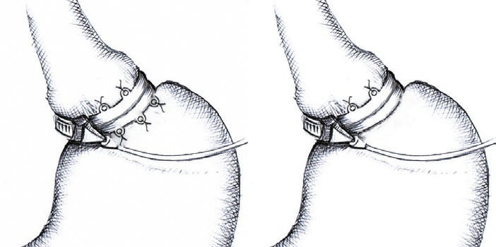 A retrospective cohort study comparing different fixation methods for the MiniMizer Extra adjustable gastric band.