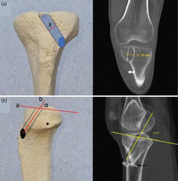Morphometric Analysis of the Tibial Tunnel after Primary and Revision Anterior Cruciate Ligament Reconstruction.