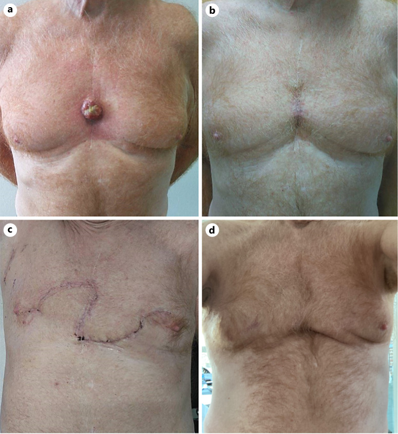 Amelanotic Melanoma Arising in Surgical Cicatrix: A Case Report.
