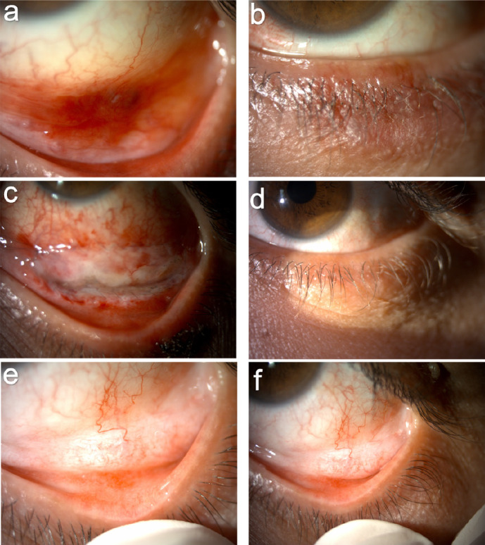 Ocular Manifestations of Kaposi Sarcoma: Insights from an HIV-Positive Patient and an Immunocompetent HIV-Negative Patient.