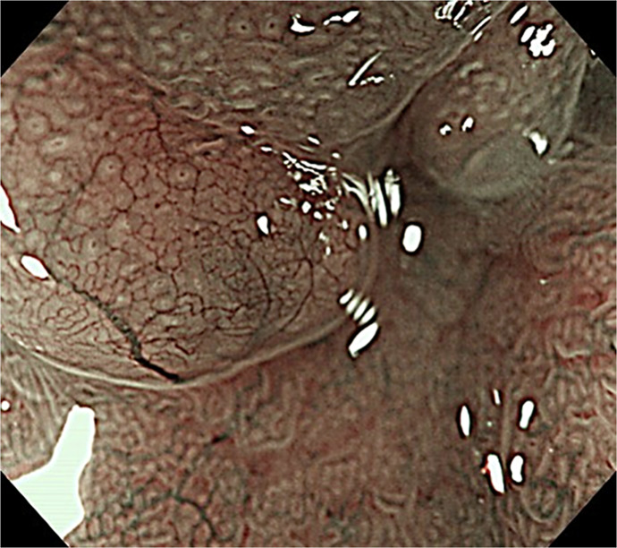 Step-Down Therapy Using Vonoprazan for Giant Gastric Polyps in Long-Term Proton Pump Inhibitor Administration.
