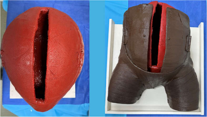 Development of a cost-effective, reusable, resuscitative hysterotomy task trainer for emergency medicine trainees.