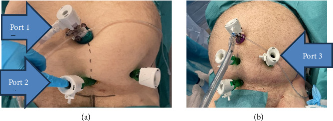 Minimally Invasive Surgical Technique for the Extraperitoneal Fixation of Acetabulum Fracture: Technical Feasibility Study in Cadaver.