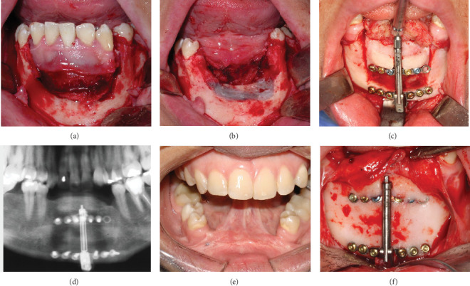 Fifteen-Year Follow-Up: Treatment of Recurrent Mandibular Giant Cell Lesion-From Resection to Rehabilitation.