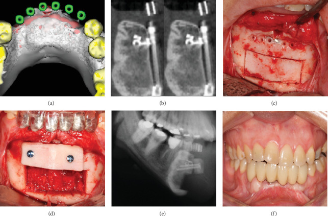 Fifteen-Year Follow-Up: Treatment of Recurrent Mandibular Giant Cell Lesion-From Resection to Rehabilitation.