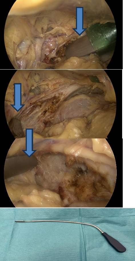 Minimally Invasive Surgical Technique for the Extraperitoneal Fixation of Acetabulum Fracture: Technical Feasibility Study in Cadaver.