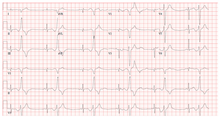 What We May not Know: Torsades de Pointes Induced by Cannabinoid Use.