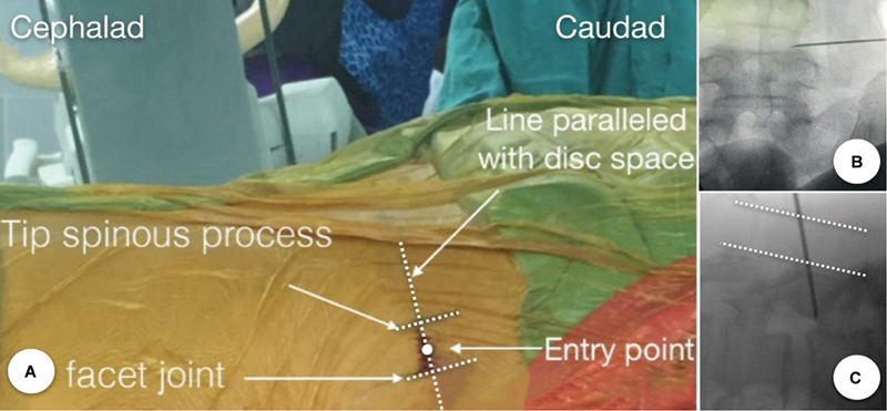 Transforaminal Percutaneous Endoscopic Discectomy for L3/4 and L4/5 Foraminal and Extraforaminal Lumbar Disc Herniation: Clinical Outcomes and Technical Note.