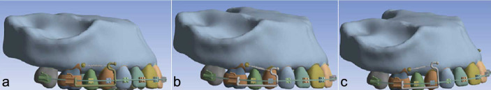 Stress Distribution and Tooth Displacement Analysis of Maxillary Molar Distalization by Different Designs of Jig in a Finite Element Study.
