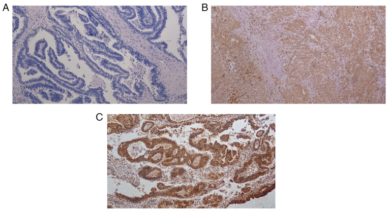 Impact of sirtuin‑1 expression on progression‑free survival in non‑endometrioid endometrial cancer: A retrospective cohort study.