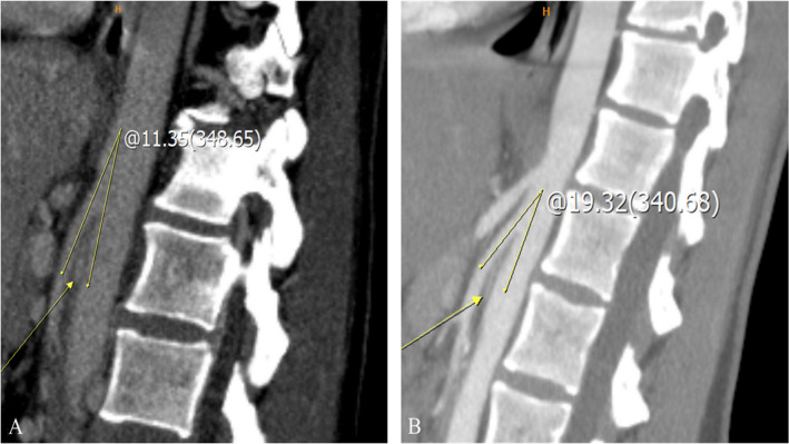 Controversies in treating nutcracker syndrome.