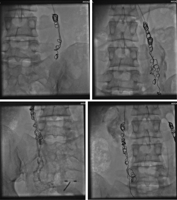Coil occlusion combined with sclerotherapy versus N-butyl-2-cyanoacrylate embolization in patients with pelvic venous disorders: A single-center retrospective study