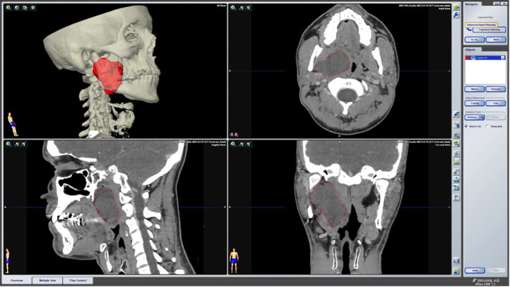 Computer-Aided excision of Parapharyngeal Space Pleomorphic Adenoma by Transcervical Approach. Case report.