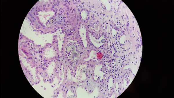 A case report of renal oxalosis and secondary hyperoxaluria due to chronic high vitamin C consumption.
